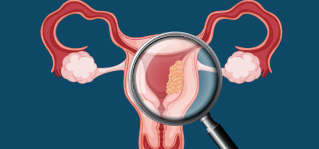 Das Endometriumkarzinom: State-of-the-Art von der Diagnose bis zur ...
